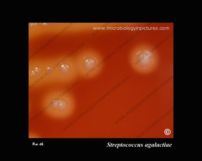 group B streptococcus